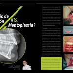 Prótesis de Mentón Vs Mentoplastia Revista Odontología Report Edición digital n35 2015