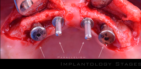 Implantologia-2