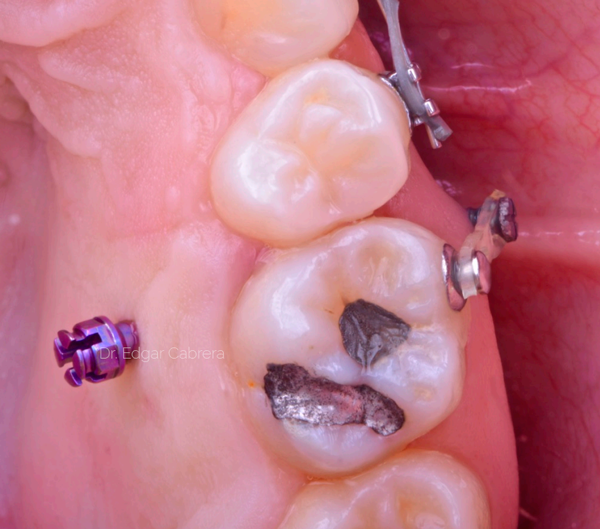 Manejo-Odontocico-Quirurgico-1